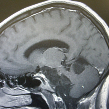 Cirugía de Quistes Cerebrales