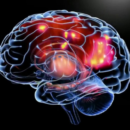 Epilepsia Generalizada