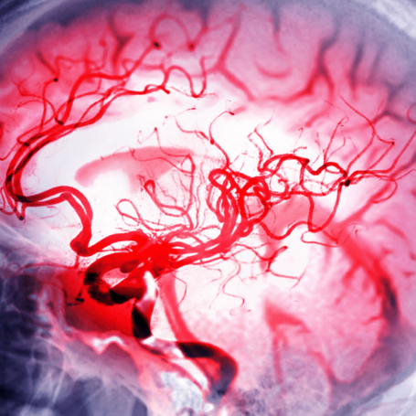 Hemorragias Cerebrales