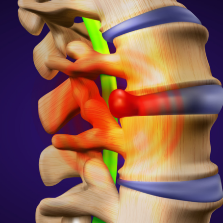 Hernias de Disco