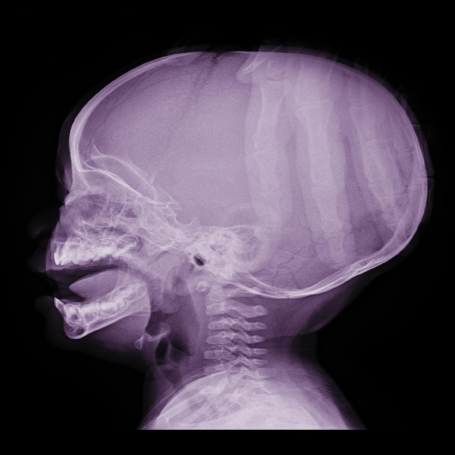 Hidrocefalia adquirida