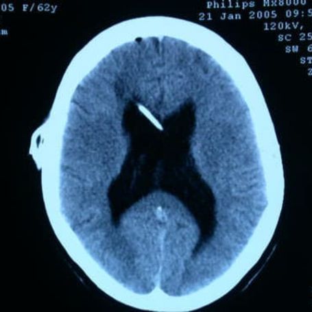 Hidrocefalia comunicante