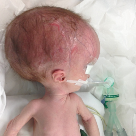 Hidrocefalia congénita