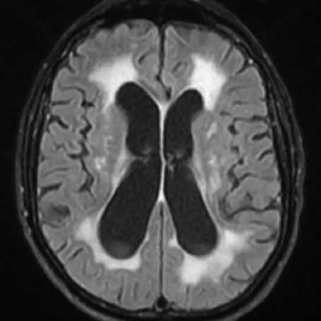 Hidrocefalia de presión normal