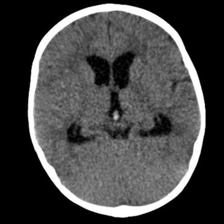 Hidrocefalia no comunicante
