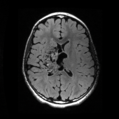 Malformaciones Arteriovenosas