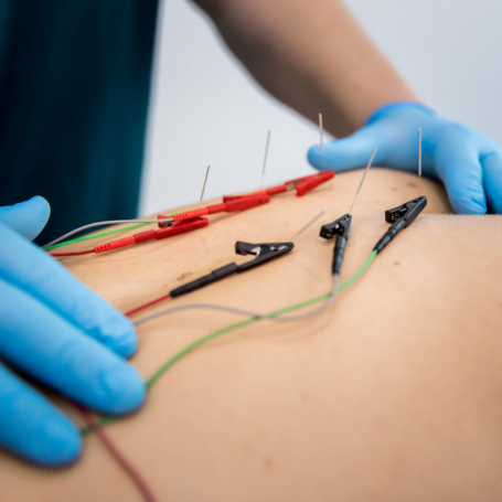 Neuromodulación espinal