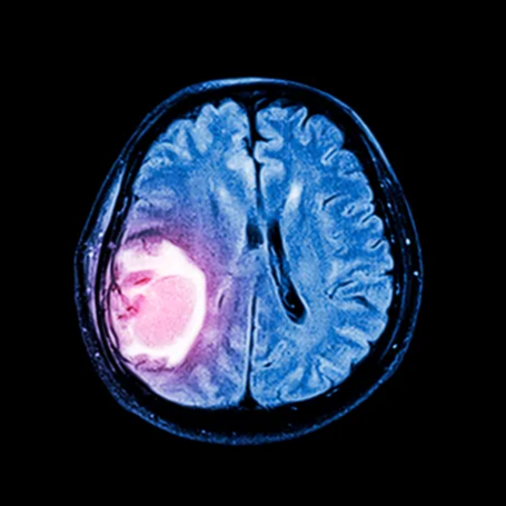 Tumores Cerebrales